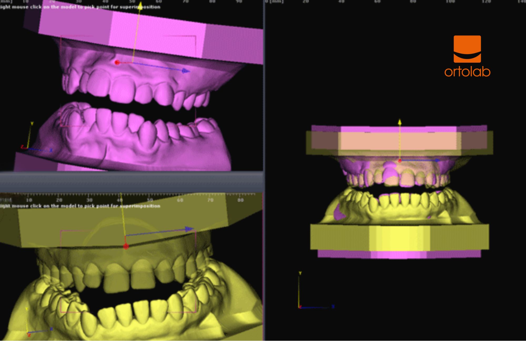 Zrzut ekranu z programu DDP-Ortho przedstawiający cyfrowe modele 3D szczęki i żuchwy z nałożonymi płaszczyznami referencyjnymi oraz układem współrzędnych. Widoczne są różne widoki modelu wykorzystywane do analizy położenia zębów i wykonywania pomiarów przestrzennych w ortodoncji cyfrowej.